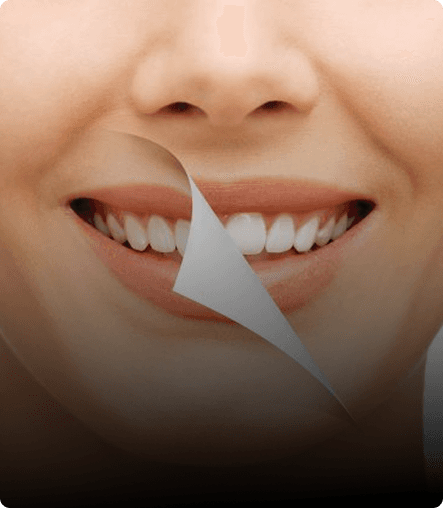 Smile Makeover
