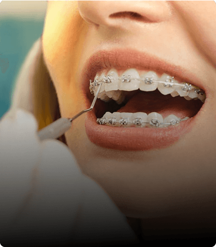 Teeth Straightening