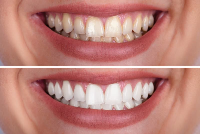 Before and after smile transformation