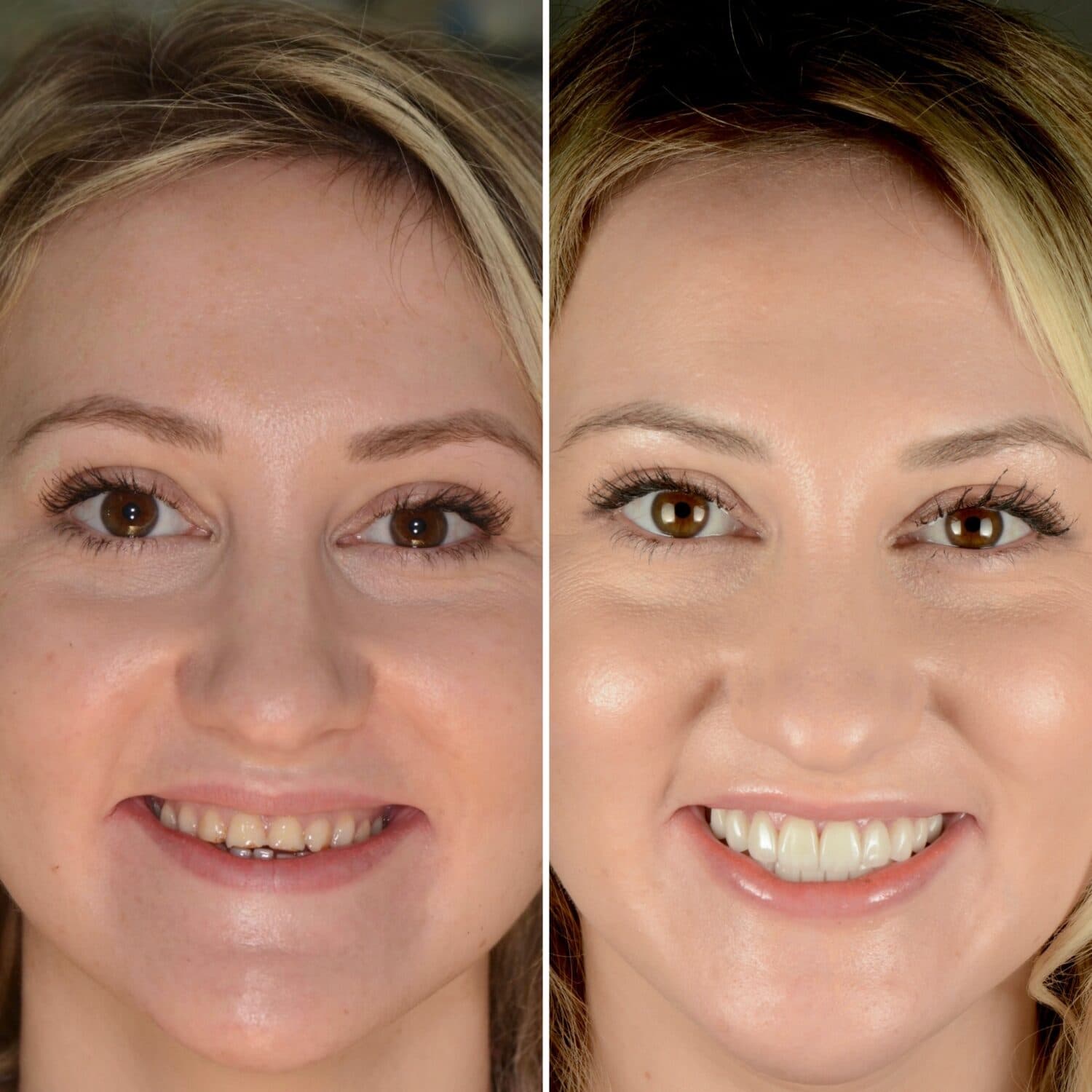 Dental implant results