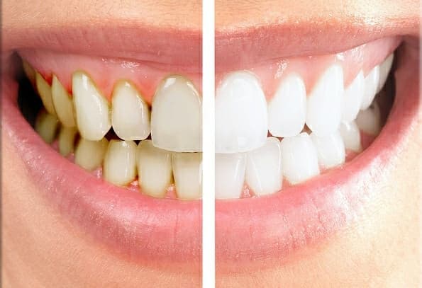 Cosmetic dentistry results